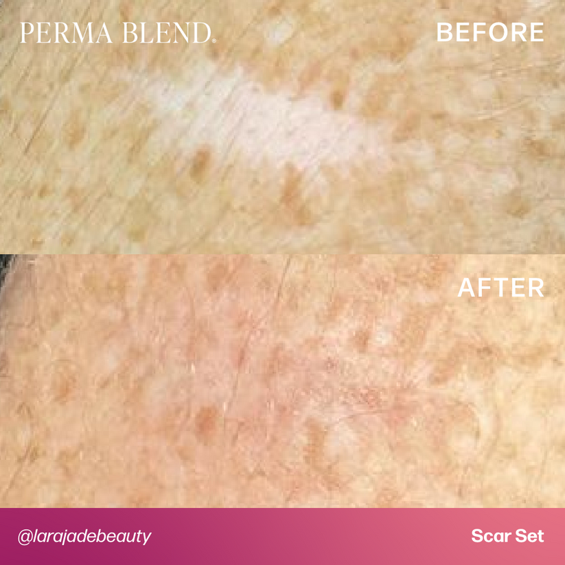 Before and after images showing the effectiveness of Permablend Light Dermis in camouflaging scars.