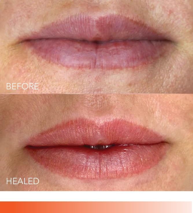 Before and after comparison of lips showing the effect of lip correction using Evenflo's Neutralizer pigment, highlighting improved color.