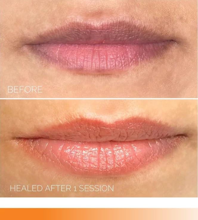 Another before and after image of lip color correction with Evenflo's Neutralizer, showcasing healing and color improvement.