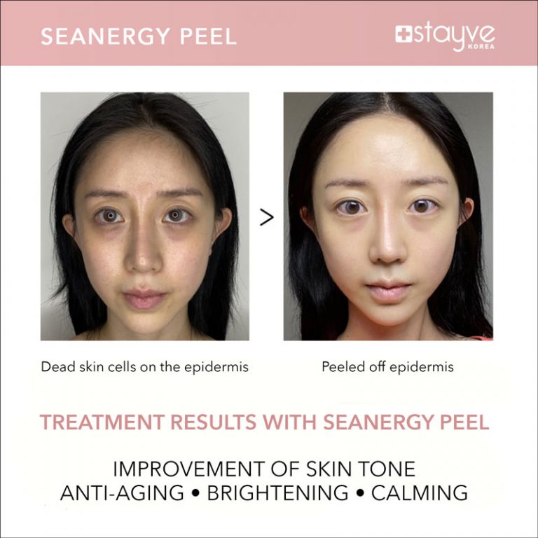 Before and after images showing the impact of Stayve Seanergy Peel on skin, demonstrating improvements in texture and clarity.