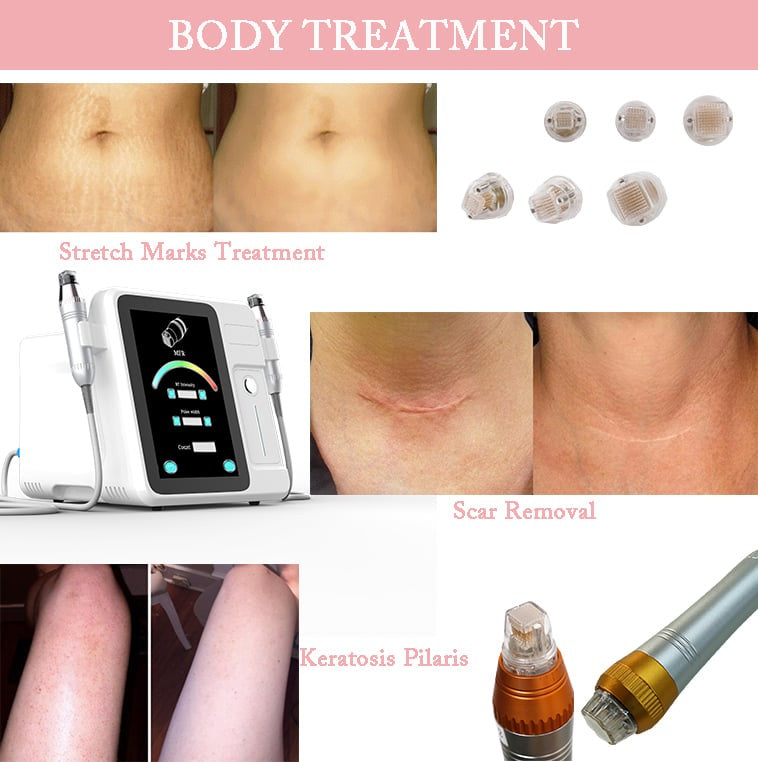The Portable Micro Needling Radio Frequency Mnrf Machine being used on a client’s face, illustrating its application in skincare.
