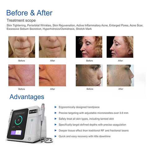 Demonstrating the Portable Micro Needling Radio Frequency Mnrf Machine's adjustable depth settings for customized skincare treatments.