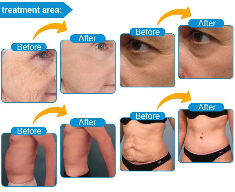 Visualization of SD Cosmetics Care 7D Hifu treatment process for achieving smoother, younger-looking skin.