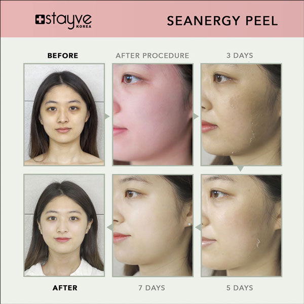 Progressive images revealing the skin transformations after using Stayve Seanergy Peel, from initial treatment through various recovery stages.