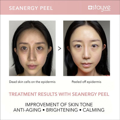 Before and after images showing the impact of Stayve Seanergy Peel on skin, demonstrating improvements in texture and clarity.