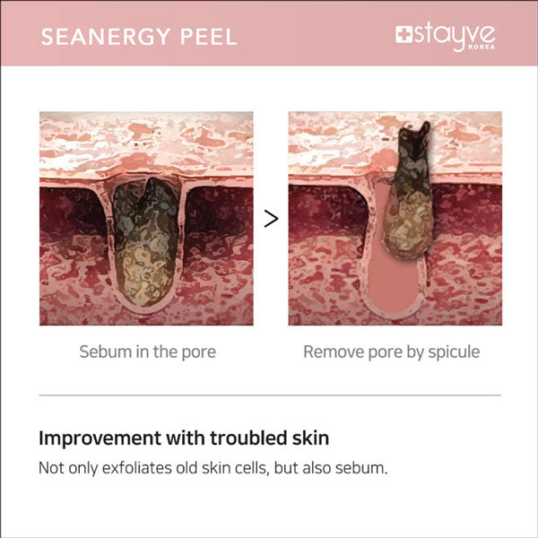 Visual representation of pores before and after applying Stayve Seanergy Peel, showcasing the cleansing process to remove sebum and impurities.
